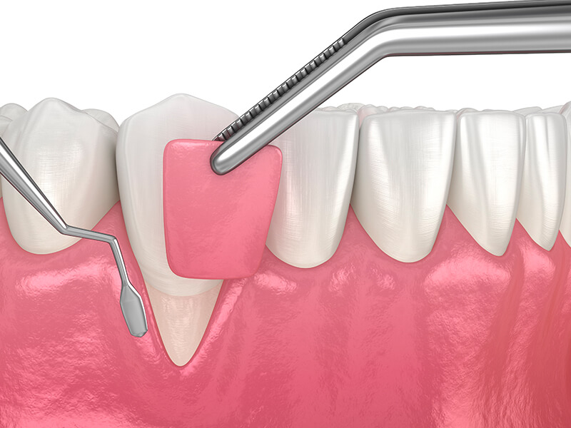 cirurgia plástica gengival